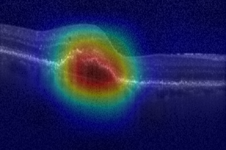 Image scan of a patient retina suffering from AMD